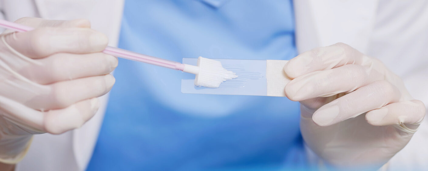 Close-up of a gynecologist placing a cervical cell sample onto glass slide after collection