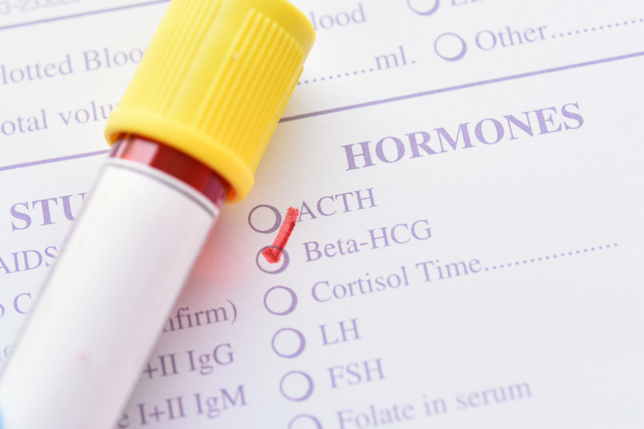 Blood sample for beta hCG (pregnancy hormone) test